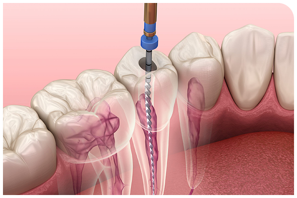 Studio Dentistico Endodonzia